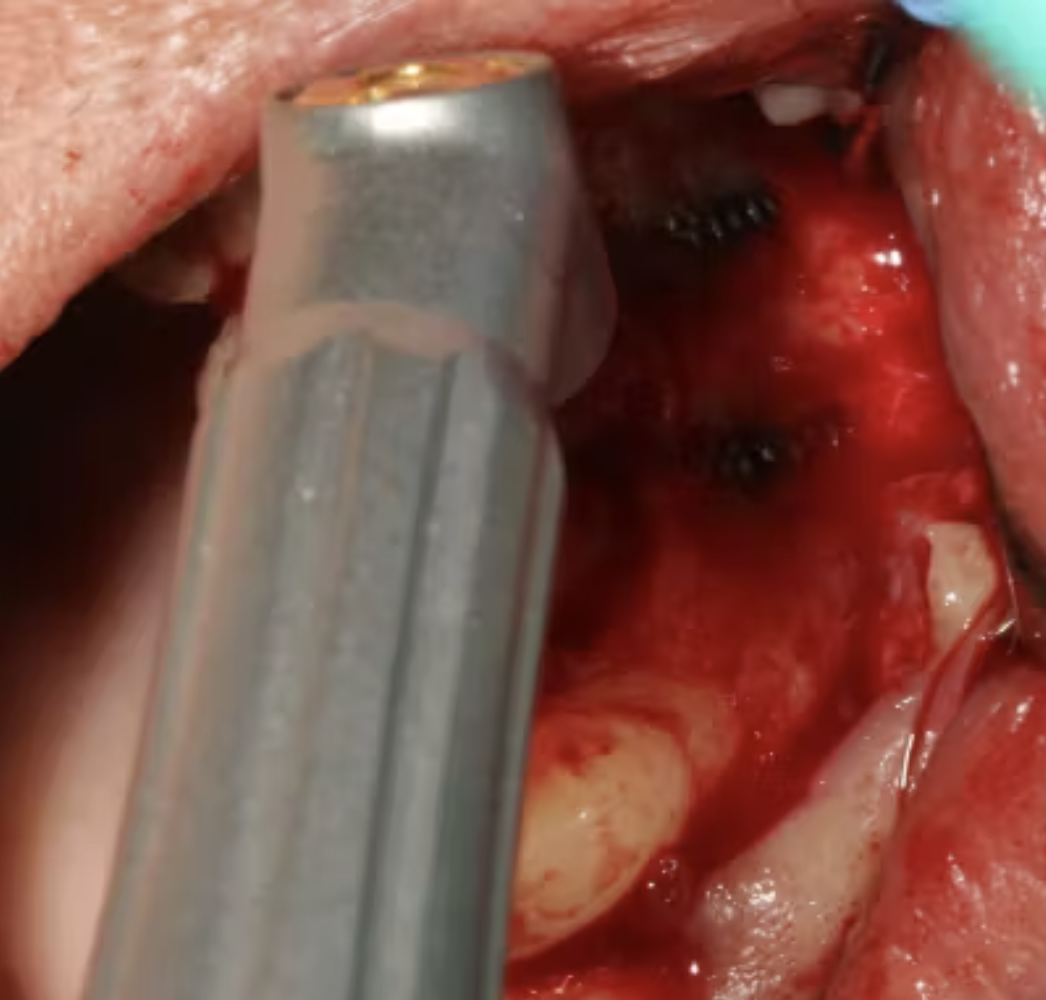 Nguyên tắc vàng khi tái cấy implant sau thất bại